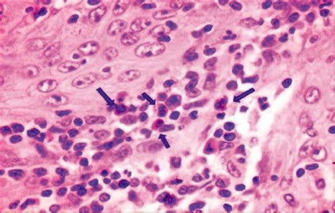 Tumor Associated Tissue Eosinophilia In Oral Squamous Cell Carcinoma