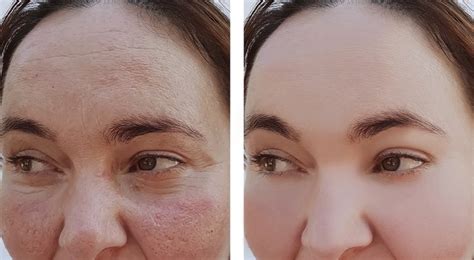 How To Get Rid Of The Skin Redness Rosacea Ozmedica