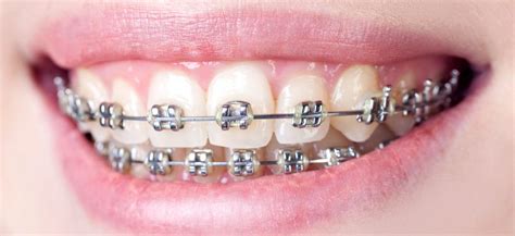 Invisalign treatment costs vary from doctor to doctor but can be comparable to the cost of traditional braces. Traditional Dental Braces vs Invisalign Aligners ...