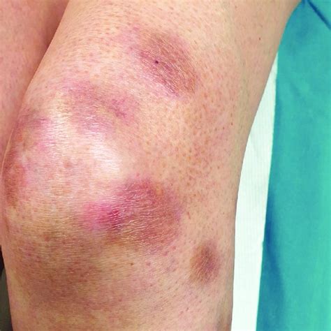Purple Erythematous Infiltrating Skin Plaques With Vesicular Features