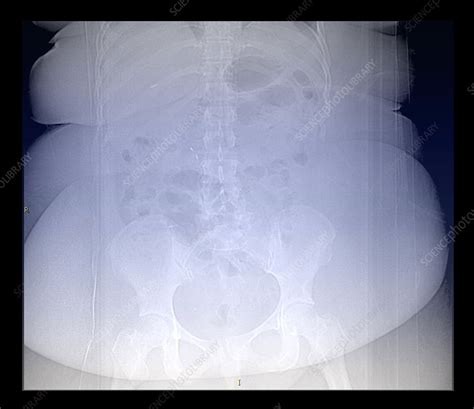 X Ray Of Morbidly Obese Patient Stock Image C0174445 Science