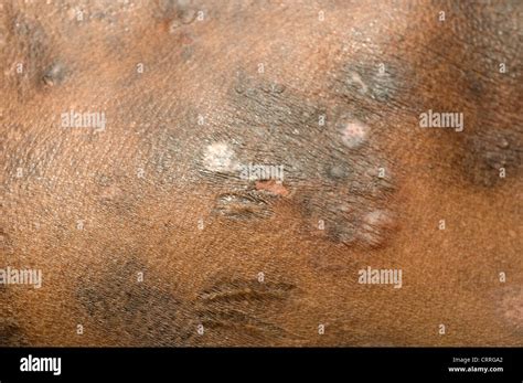 Fungal Infection Skin High Resolution Stock Photography And Images Alamy