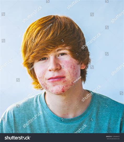 Smart Happy Boy In Puberty With Acne Stock Photo 123646423 Shutterstock