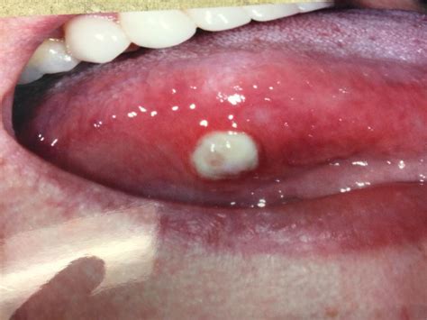 Canker Sore On The Tongue Picture And Treatment Dr