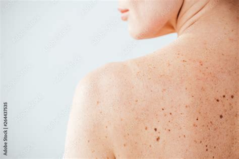 Cropped View Of Diseased And Naked Woman With Moles On Skin On White