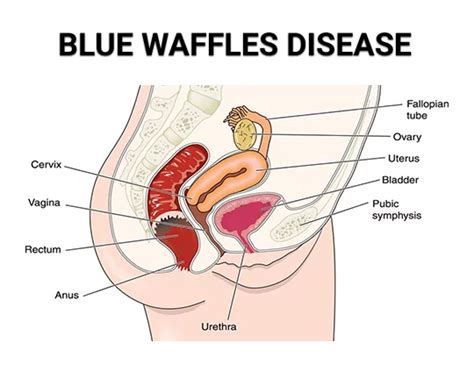 Is Blue Waffles Disease Real What A Gynecologist Thinks Century Medical Dental Center