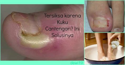 Anda Pastinya Tersiksa Banget kan Karena Kuku Cantengan ...