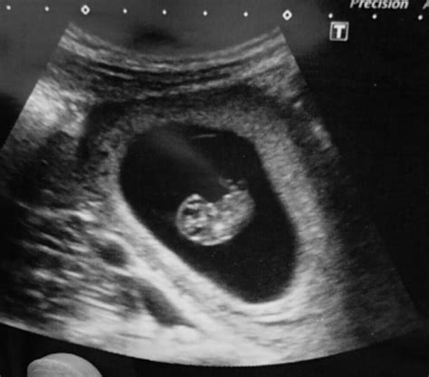 Ultrasound Scans At 8 Weeks Pics