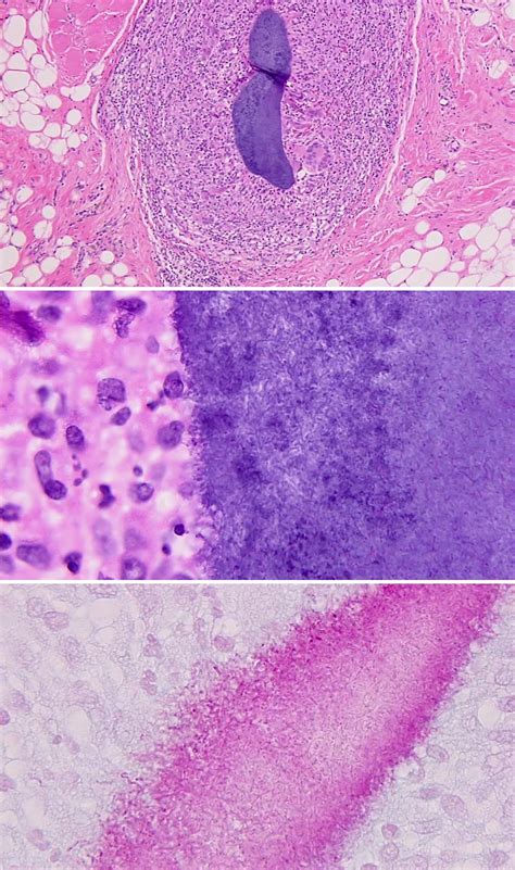 Pathology Outlines Nocardia