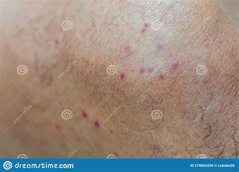Mancha Roja Y Cicatriz Por Picaduras De Mosquito Foto De Archivo Imagen De Dolor Sano