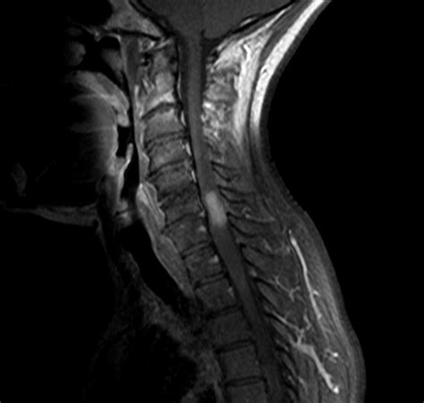 Krankheitsschübe wie auch läsionen in der magnetresonanztomographie (mrt) reflektieren den krankheitsprozess bei der… teriflunomid reduziert den jährlichen verlust an hirnvolumen frankfurt, 02. MRI of the cervical spine, sagittal view: contrast enha ...