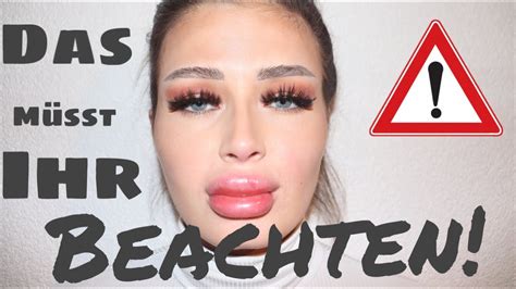 SCHWELLUNG LINDERN BEI UNTERSPRITZTEN LIPPEN Aufgespritzte Lippen Zu Sehr Geschwollen YouTube