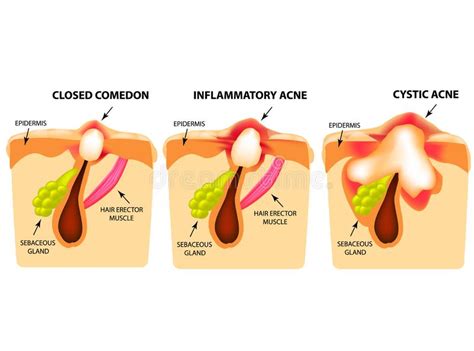 Types Of Acne Skin Inflammation Pimples Boils Whitehead Closed