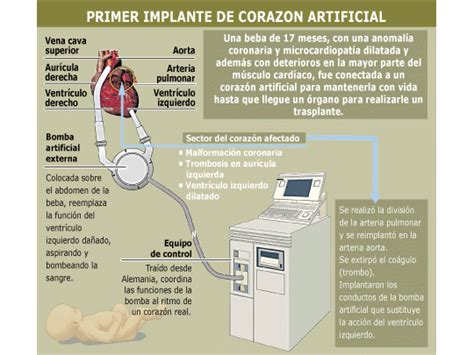 Realizan El Primer Implante De Corazón Artificial En El País