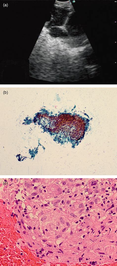 Review Of The Role Of Ebus‐tbna For The Pulmonologist Including Lung