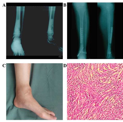 Late Post‑operative Recurrent Osteosarcoma Three Case Reports With A