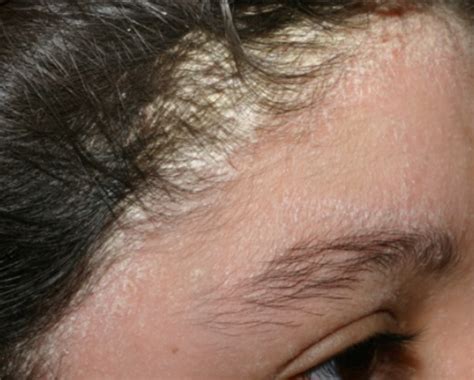 Seborrheic Dermatitis Blog Vibrant Dermatology