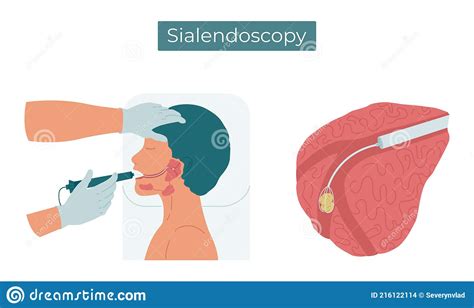 Sialendoscopy Surgery To Remove A Stone From The Duct Of The Parotid
