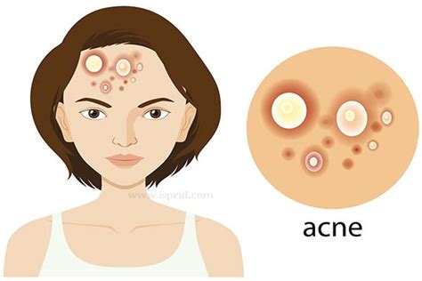 Acne Everything You Should Know I Sprid