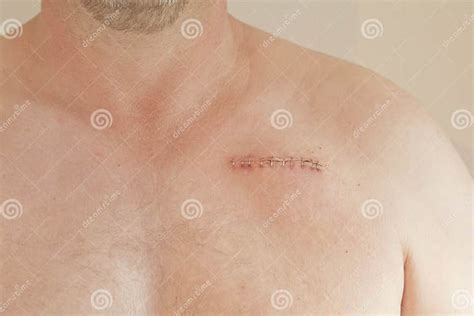 Pacemaker Scar Stock Image Image Of Implant Murmur 25735675