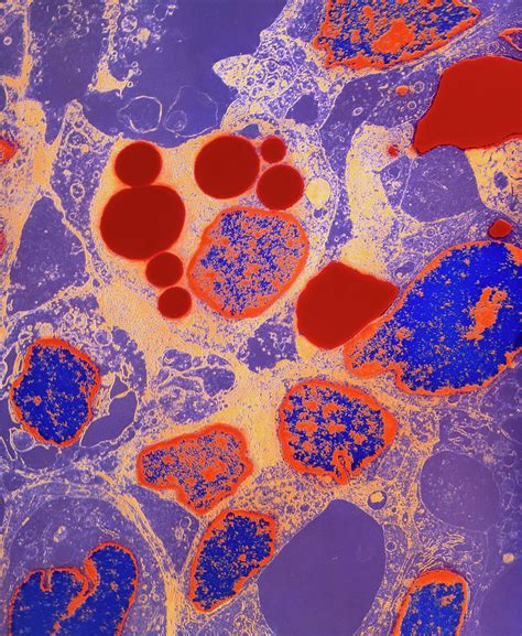 Coloured Tem Of Kaposis Sarcoma A Skin Cancer Photograph By Science