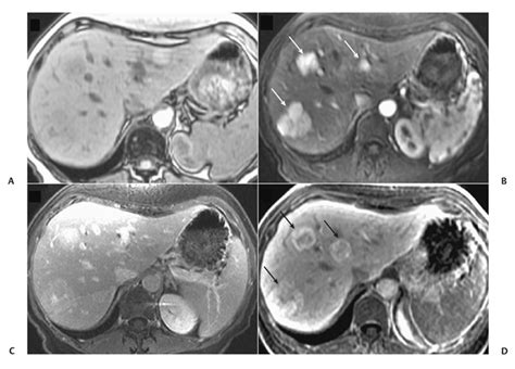 5 Pyogenic Liver Abscess Radiology Key