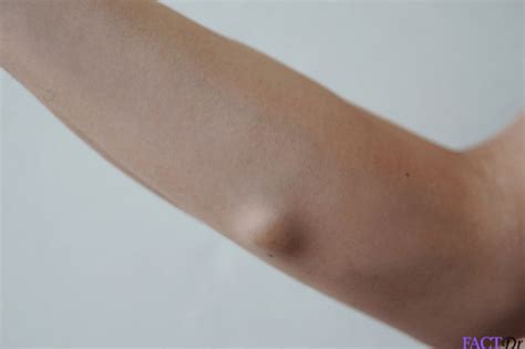 Sebaceous Cyst On Arm