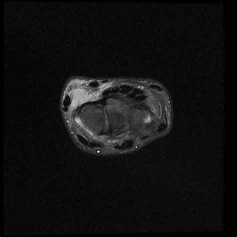 Giant Cell Tumor Of The Tendon Sheath Image Radiopaedia Org