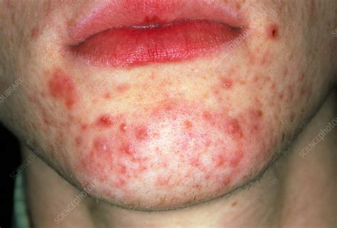 Acne On Chin Stock Image M1080510 Science Photo Library