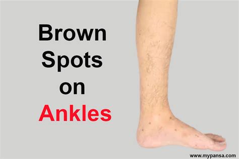 Brown Spots On Ankle Causes Symptoms And Treatments For 2021