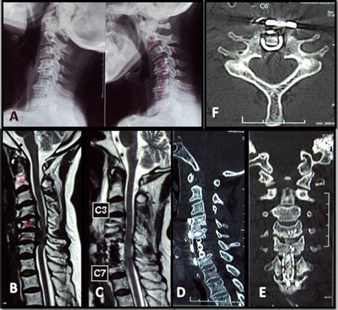 A Preoperative Flexion And Extension Images Of Cervical Spine Showing