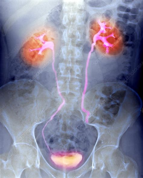 Urinary System X Ray Stock Image P5560078 Science Photo Library