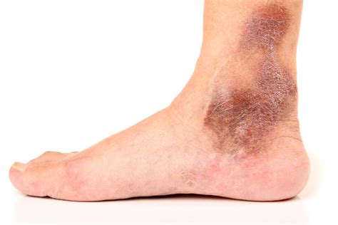 Spider Veins Along The Ankle Indicate Underlying Reflux Disease La