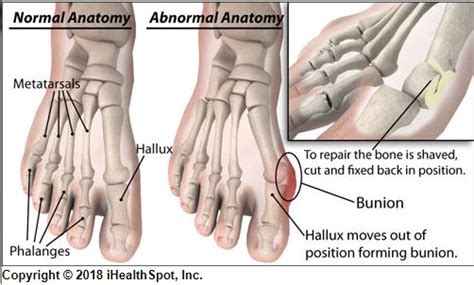 Bunion Joint Pain Missoula Bone And Joint