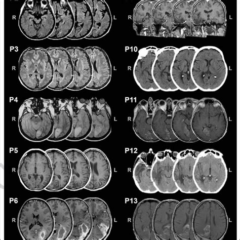 Ct Or Mri Scans Of Patients All The Scans Are Presented In Axial Views