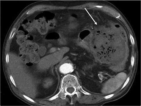 Abdominal Contrast Enhanced Computed Tomography Ct Findings An