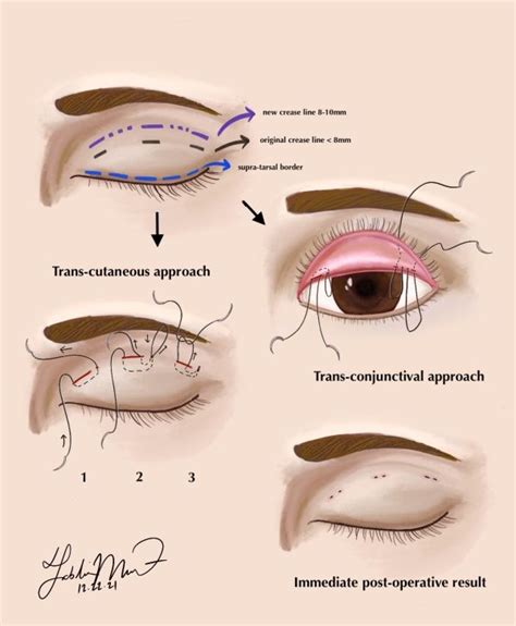 Asian Blepharoplasty Double Eyelid Procedure Eyewiki