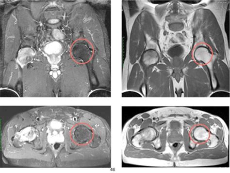 Frontal And Transverse T1 And T2 Weighted Mri Of The Pelvic Region