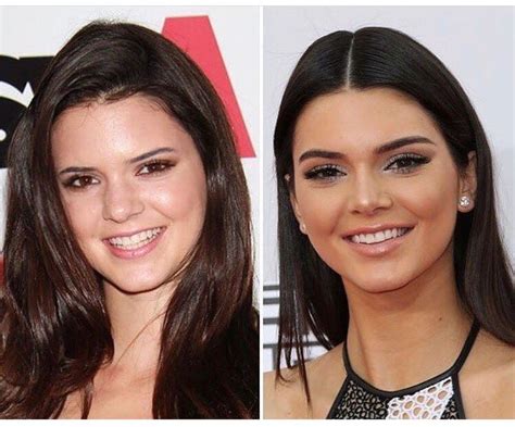 Kendall Jenner Before And After Kendall Jenner Nose Job Kendall Jenner Plastic Surgery