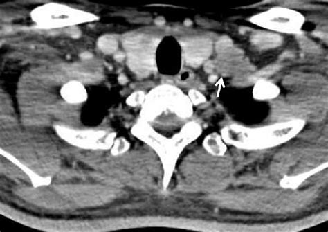 Neck Computed Tomography Showed Multiple Cervical Lymphadenopathy