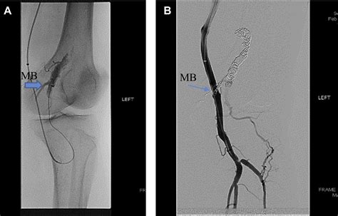 Endovascular Approach To Arterial Branches Mimicking A Type Ii Endoleak