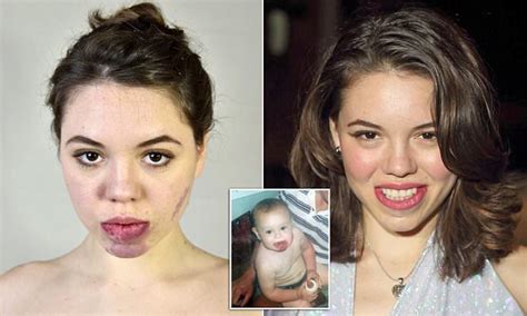 Model Celina Leroy Who Spent 15k Trying To Cover Facial Birthmark Goes