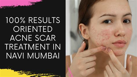Acne Scar Removal Treatment In Navi Mumbai The Cost Of Acne Scar