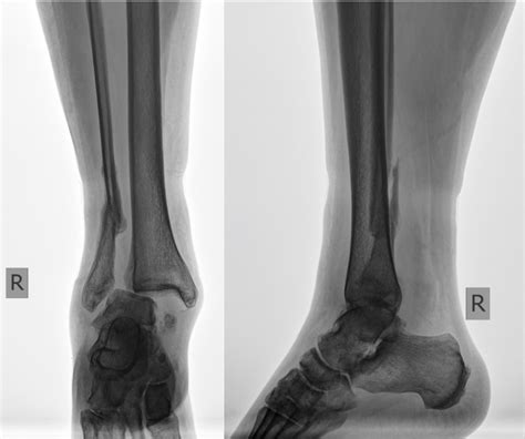 38 Yo Patient With Distal Fibula Malunion After Suprasyndesmotic Ankle