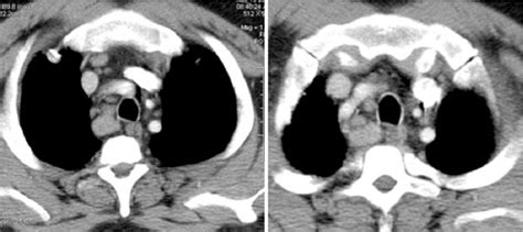 Figure 2 From Unilateral Vocal Cord Paralysis A Review Of Ct Findings