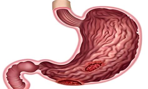 A Look Into The Causes Symptoms And Treatment Of Stomach Ulcers