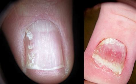 Nail Psoriasis On The Hands And Feet Causes Diagnosis And Symptoms