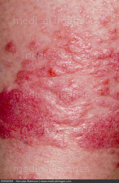 Stock Image Dermatology Severe Lichen Planus A Patch Of Purple Red
