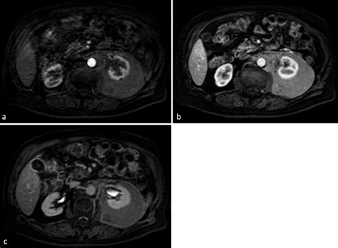 Mri Of The Kidneys Axial Contrast Enhanced T1 Fat Saturated
