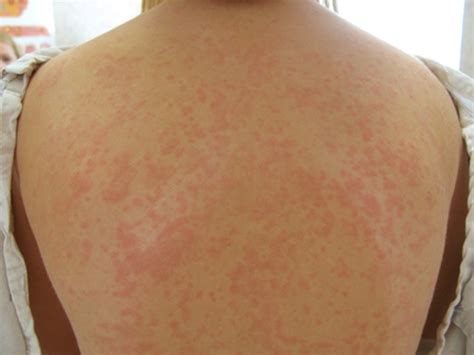 Viral Exanthem Pictures Treatment Symptoms Causes